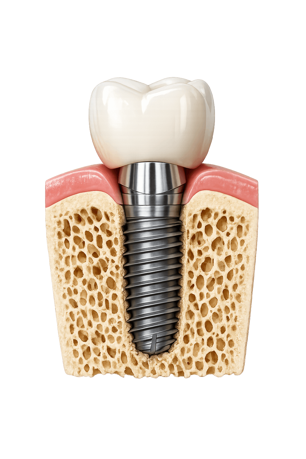 Implante dentário — estrutura e coroa