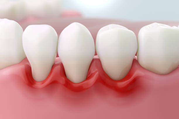 Saúde Periodontal