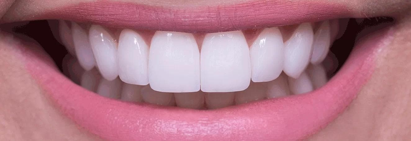 Lentes de Contato Dental 3D: Planejamento digital é o segredo do sorriso natural?